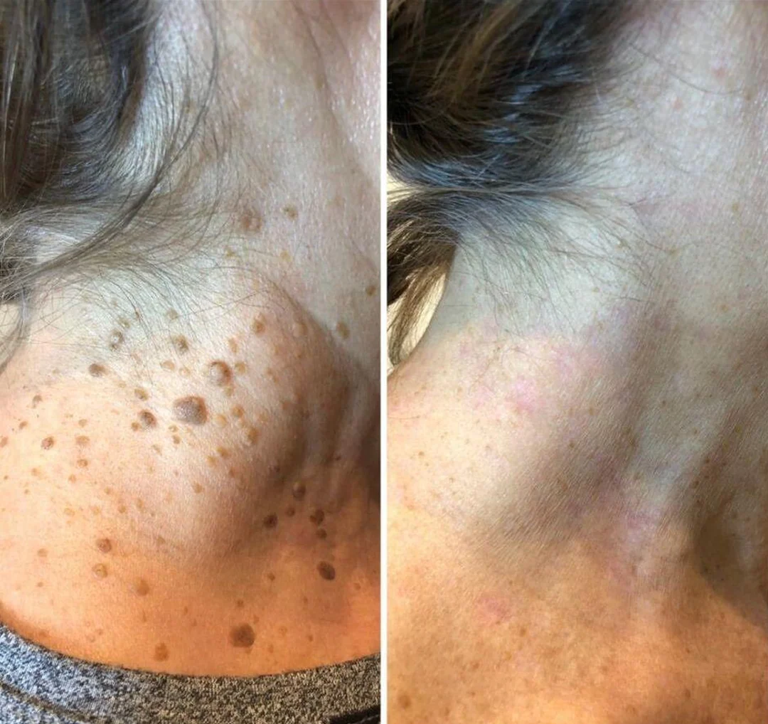 CryoClear Pro Bump Renewal Spray